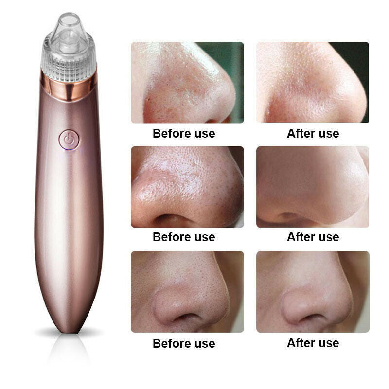 Electric Blackhead Remover – Strong Suction Pore Vacuum Cleaner